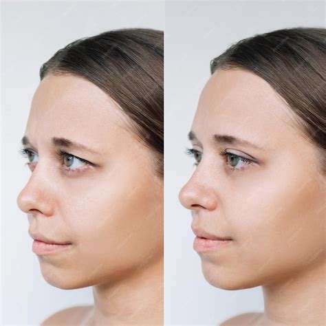 Premium Photo | Young woman face with drooping upper eyelid before
