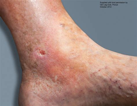 venous ulcer treatment exploring treatments  venous leg ulcers