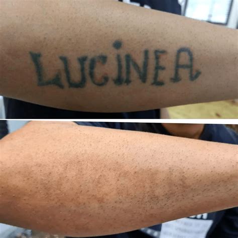 Como Fica A Pele Depois De Remover Tatuagem - Antes E Depois De Remoção De Tatuagem - NAZAEDU