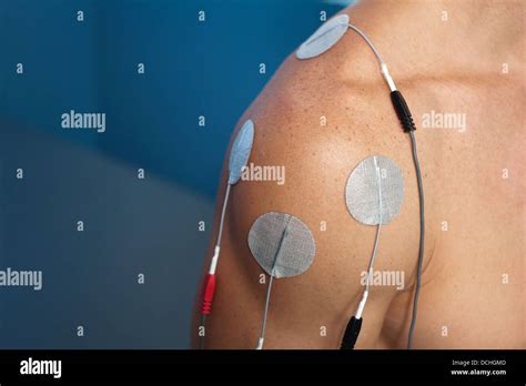 Transkutane elektrische -Fotos und -Bildmaterial in hoher Auflösung – Alamy