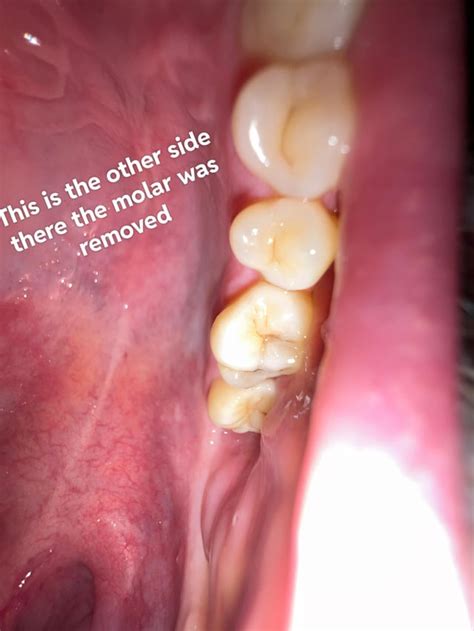molar broken   remove    filled  raskdentists
