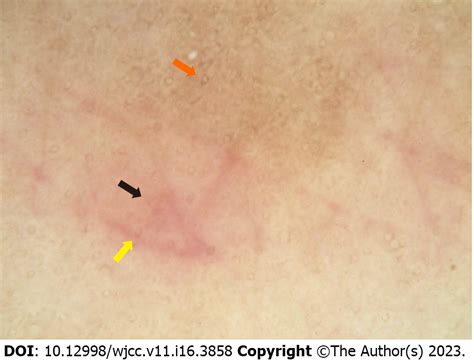 purpura annularis telangiectodes  majocchi  case report
