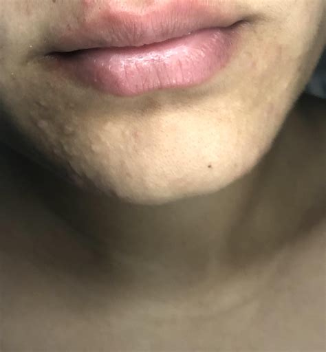 [Skin Concern] Textured spots on chin don’t go away : r/SkincareAddiction