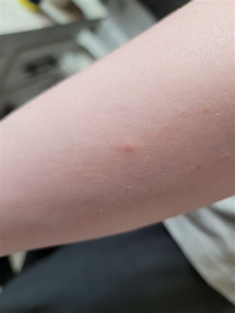 Early ringworm or something else? : r/Dermatology