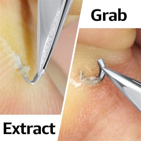 Durox Splinter Remover Tweezers - First Aid Tool for Splinter Removal