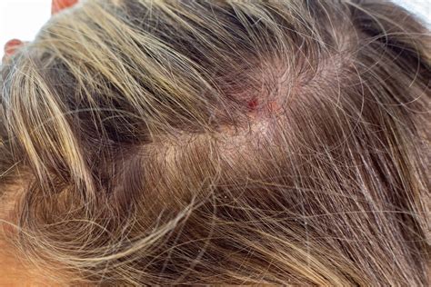 Prurigo Nodularis on Scalp — Identification and Treatment | MyPrurigoTeam