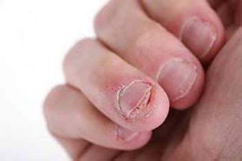 Roer Unhas Faz Mal