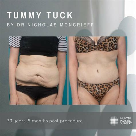 Tummy tuck newcastle body contouring hunter plastic surgery – Artofit