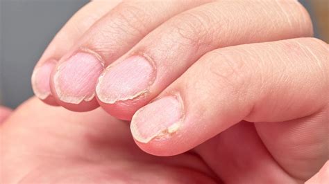 Unhas Fracas E Descamadas - Tem unhas fracas? Veja 5 formas de solucionar o problema