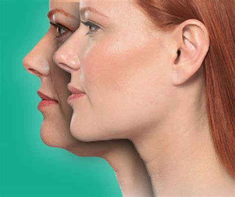 Double Chin Surgery - Health & Beauty Turkey