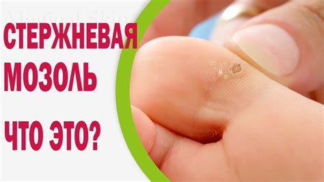 Стержневая мозоль - что это такое и как она выглядит - YouTube