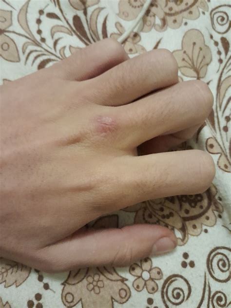 Создать мем "мозоль на кисти руки, пятна на руках, зуд на кистях ...