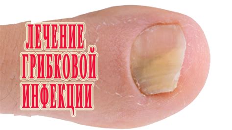 ★Лечение Грибка стопы и ногтей на ногах. Причины. Виды. Симптомы ...
