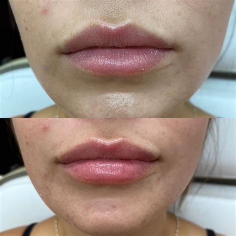 Before & After Treatment Results - Mesa AZ | Emily Frost Aesthetics
