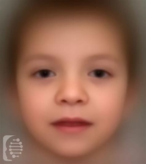 Wide Set Eyes Syndrome