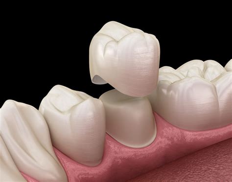 how much does it cost to cap a tooth