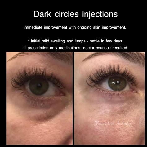 Dark circles under eyes - Vista Clinic Melbourne Australia