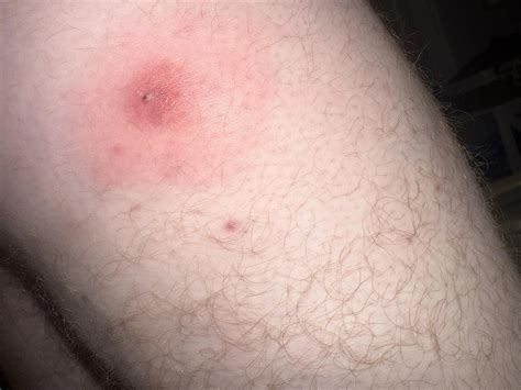 The Doctor's - Strange red lump on the back of my right thigh. Noticed