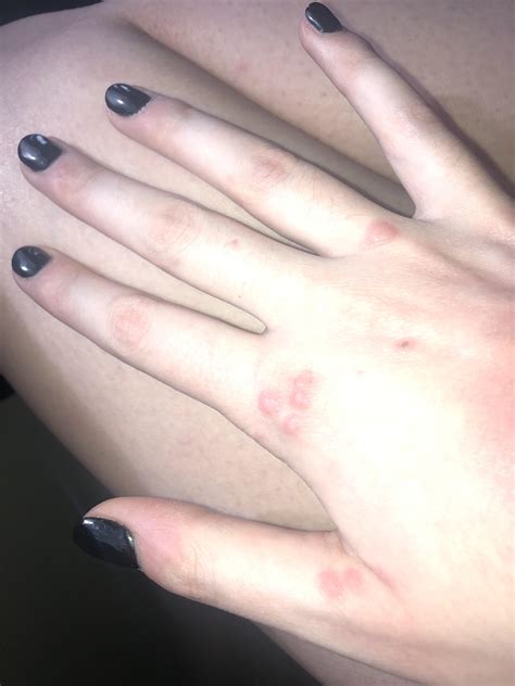 The large popping cysts medical mystery that baffled doctors 5