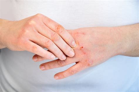 alergi ikan homecare
