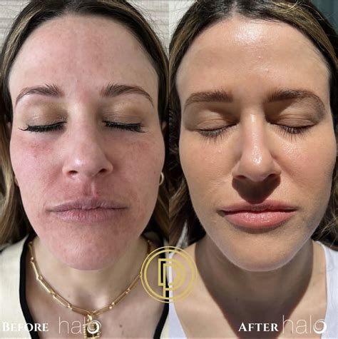 halo laser treatment dallas dallas dermatology partners