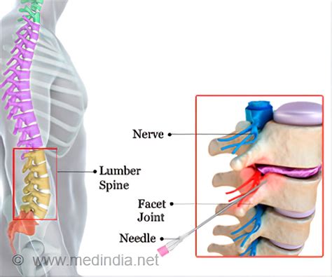 Rhizotomy - Procedures, Risks & Complications