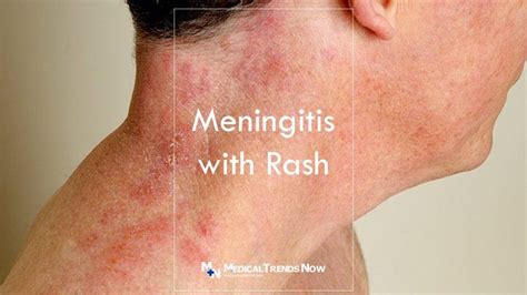 Meningitis With Rash: What is It and How to Treat – Medical Trends Now