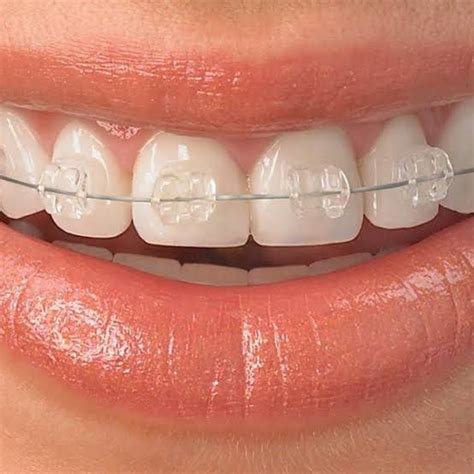 Qual O Valor Para Colocar Aparelho Nos Dentes - Quanto Custa para Colocar Aparelho nos Dentes em 2025?