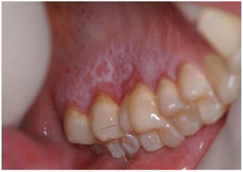 papules on tongue 1