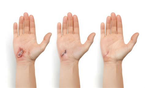 wound healing stages process  medicine guide