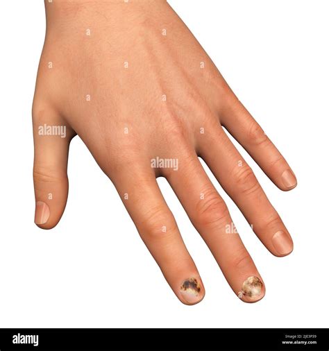 Fungal nail infection, illustration. Known as onychomycosis, or tinea ...
