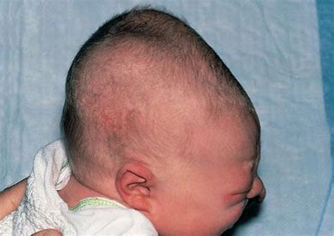 Cephalohematoma - MEDizzy