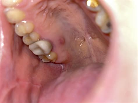 Pimple/lump on roof of mouth. Could it be oral cancer? : askdentists