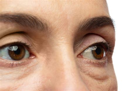 penyebab mata bengkak bagian bawah ketahui yuk