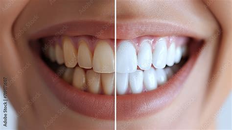 Radiant smile evolution before and after dental whitening ...