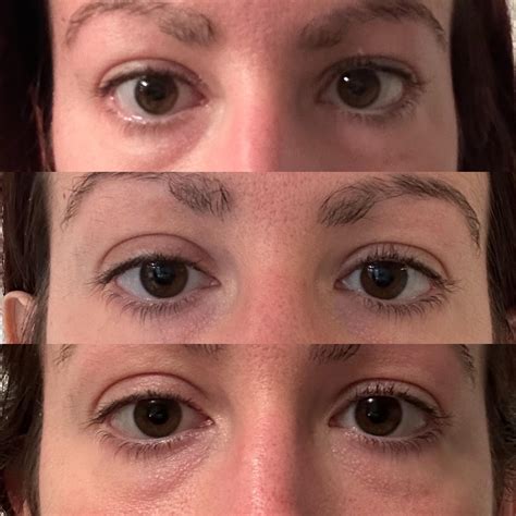 mild ptosis rmyastheniagravis
