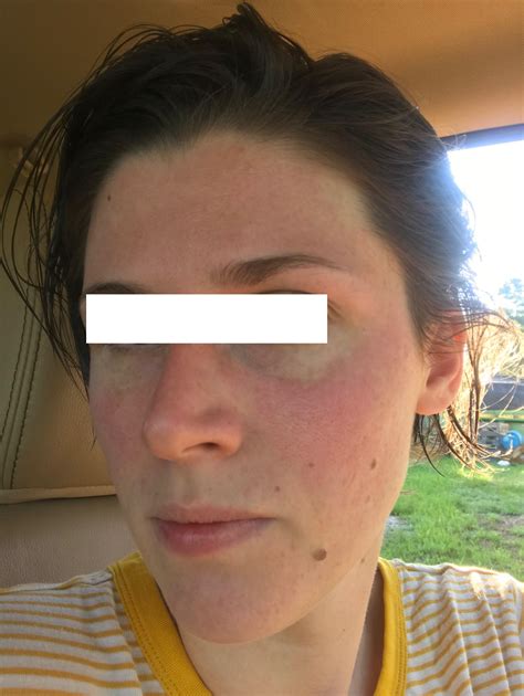 Lupus Butterfly Rash Treatment