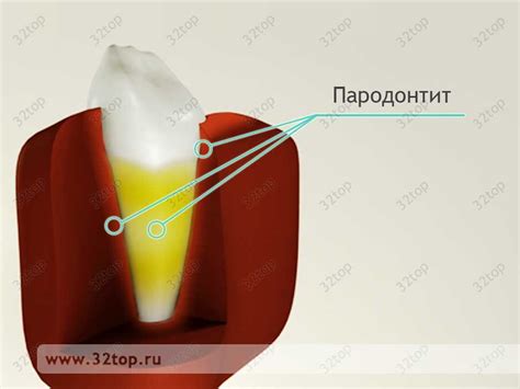 Метронидазол при лечении пародонтита - denta