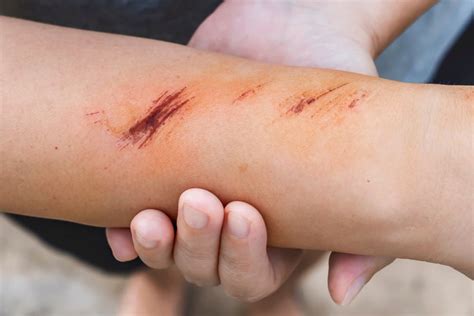 menghilangkan bekas luka  tepat  sehat