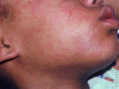 rubella  rubeola measles differences    goodrx