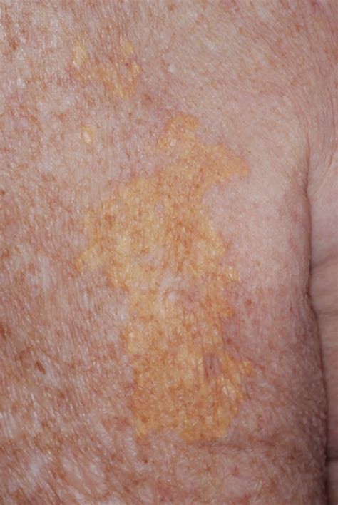 Xanthoma eye, tendinous, tuberous and disseminatum causes & treatment