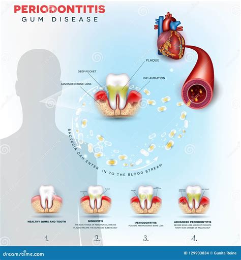 Periodontitis Gum Disease Problems Stock Vector - Illustration of gums