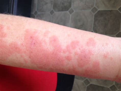 sun rash