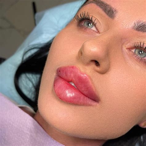 FILLER LABBRA | Tutto quello che dovresti sapere