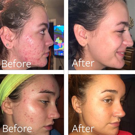 Dr Song Benzoyl Peroxide Wash 10% - Acne Treatment for Face & Body