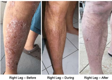 Psoriasis On Legs