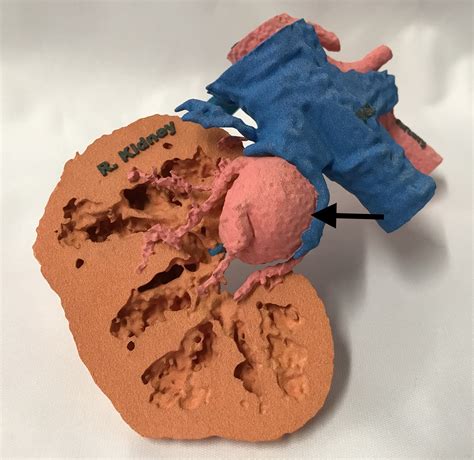 3D Printing: Bridging the Gap Between Radiologists and Surgeons