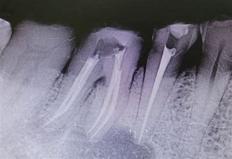 Root Canal Retreatment