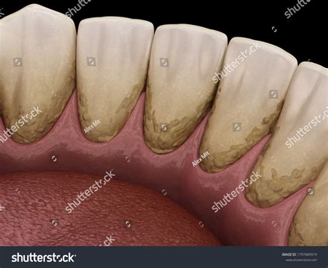 9,456 Tartar On The Teeth Images, Stock Photos, 3D objects, & Vectors | Shutterstock