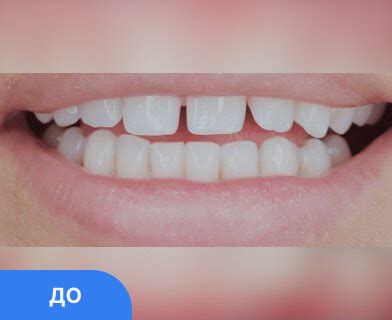 Виниры установка недорого - стоимость от 7500 руб. E-MAX - 25000 руб ...